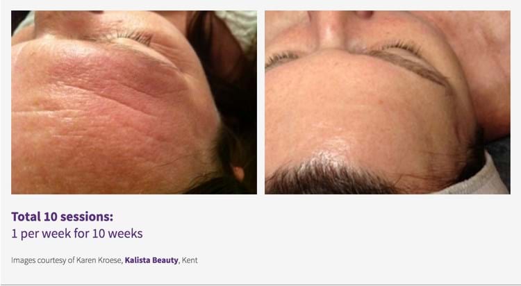 Results-Skin Rejuventaion