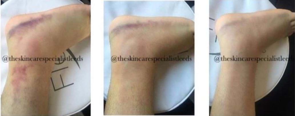 Wound healing & pain relief