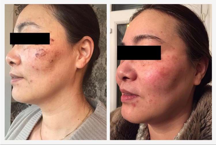 Results- Pigmentation