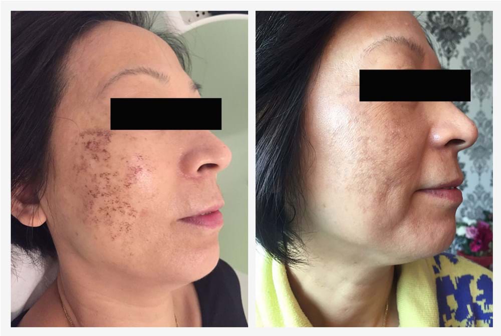 Results- Pigmentation