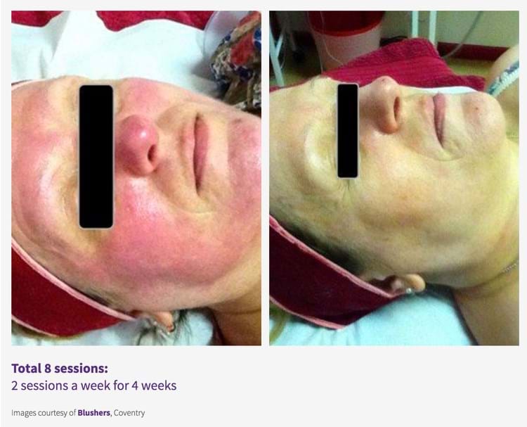 Results -Rosacea and redness