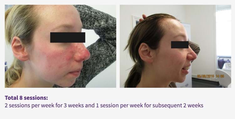 Results -Rosacea and redness