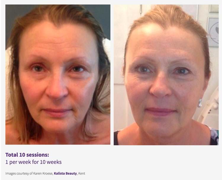 Results-Skin Rejuvenation