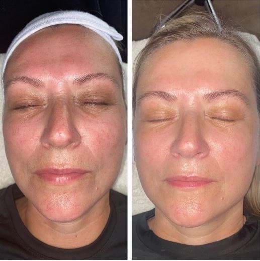 Skin rejuvenation